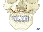 palatoalveolar complex injury