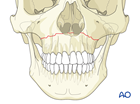 approach to the le fort i level of the midface in cleft lip and palate patients