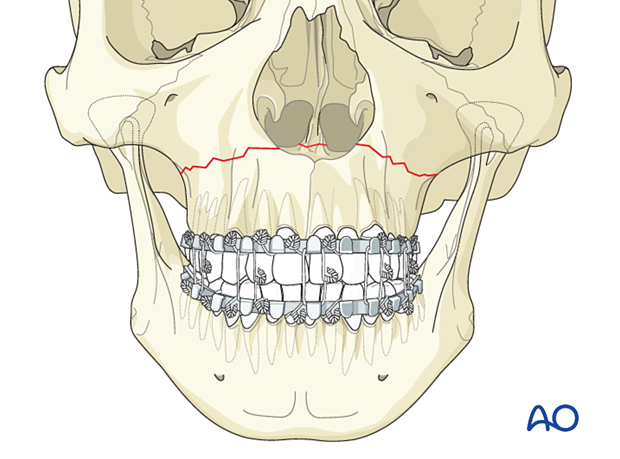 Le Fort I linear fracture : closed treatment 