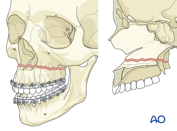 Le fort I linear fracture - open reduction internal fixation: Reduction 