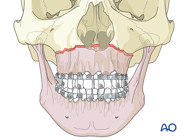 Le fort I linear fracture - open reduction internal fixation: Reduction 
