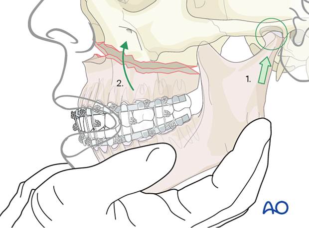 Le fort I linear fracture - open reduction internal fixation: Reduction 