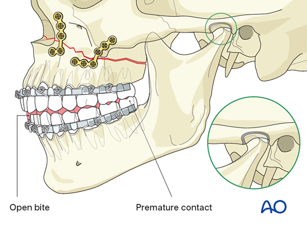 Le fort I linear fracture - open reduction internal fixation: Check of occlusion 