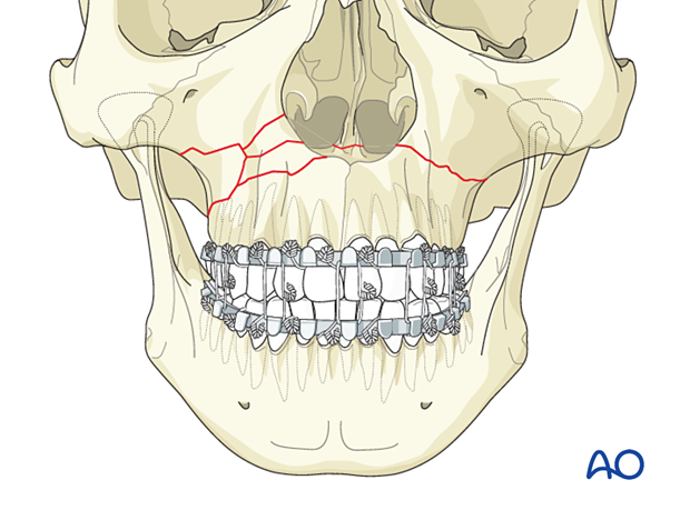Le Fort I, unilateral comminution - Treatment