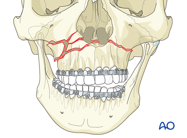 92_P140_i005 Le Fort I unilateral comminuted fracture - open reduction internal fixation: Reduction