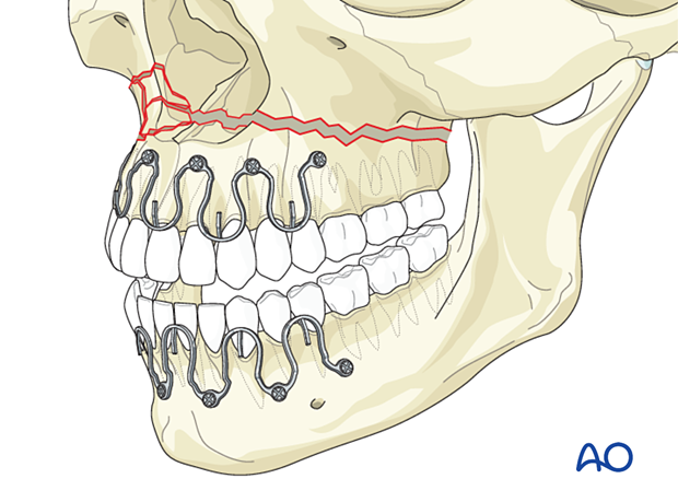 92_P140_i010 Le Fort I unilateral comminuted fracture - open reduction internal fixation: Reduction