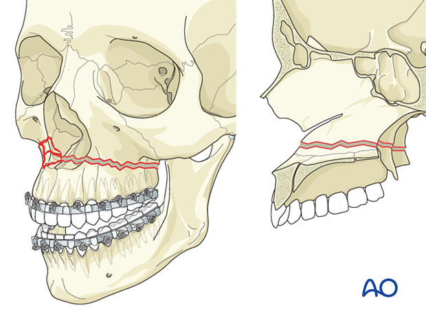 92_P140_i020 Le Fort I unilateral comminuted fracture - open reduction internal fixation: Reduction