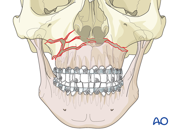 92_P140_i040 Le Fort I