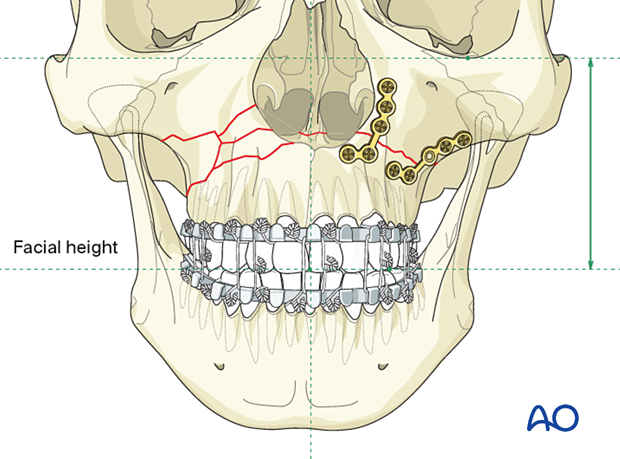 92_P140_i050 Le Fort I unilateral comminuted fracture - open reduction internal fixation: Fixation