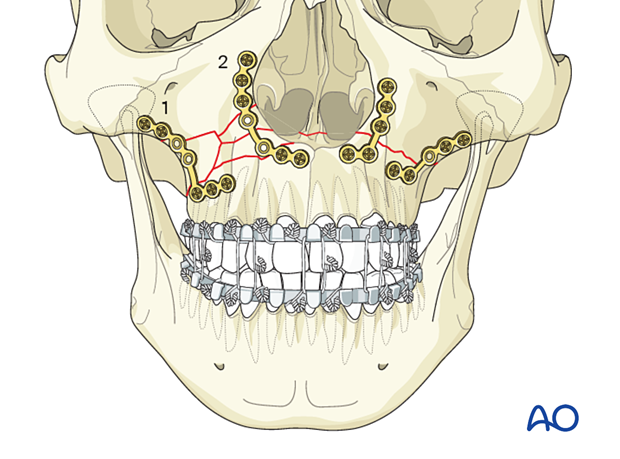92_P140_i060 Le Fort I unilateral comminuted fracture - open reduction internal fixation: Fixation
