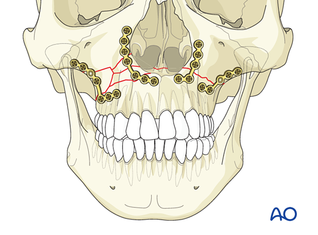 92_P140_i070 Le Fort I unilateral comminuted fracture - open reduction internal fixation: Fixation