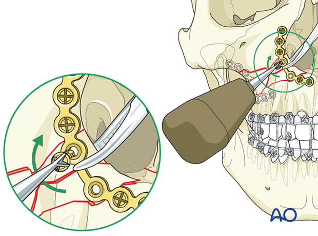 Le Fort I unilateral comminuted fracture - open reduction internal fixation: Fixation 