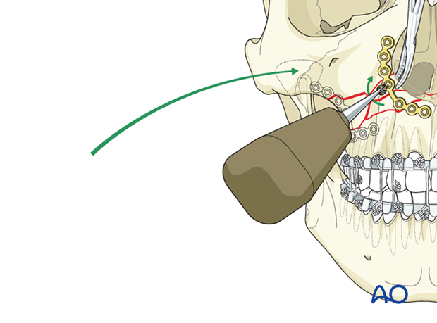 Le Fort I unilateral comminuted fracture - open reduction internal fixation: Fixation 