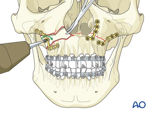92_P140_i110 Le Fort I unilateral comminuted fracture - open reduction internal fixation: Fixation (comminution with defect)