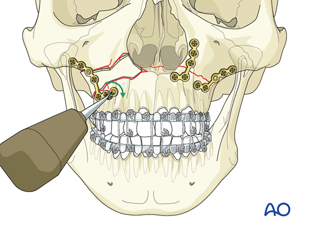 92_P140_i120 Le Fort I unilateral comminuted fracture - open reduction internal fixation: Fixation (comminution with defect)