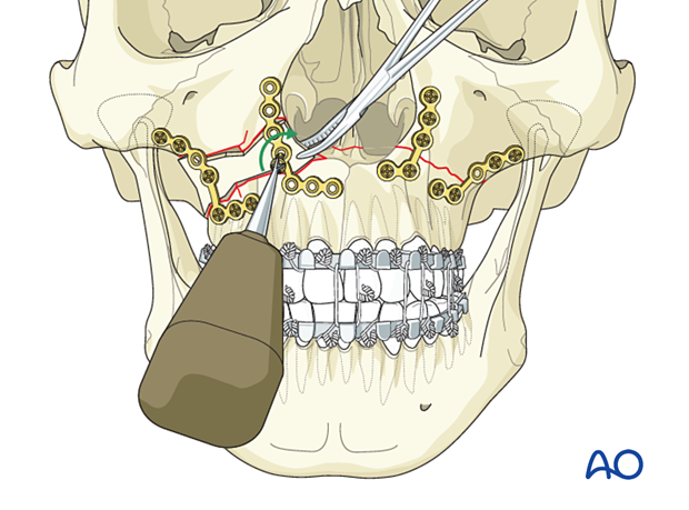 92_P140_i130 Le Fort I unilateral comminuted fracture - open reduction internal fixation: Fixation (comminution with defect)