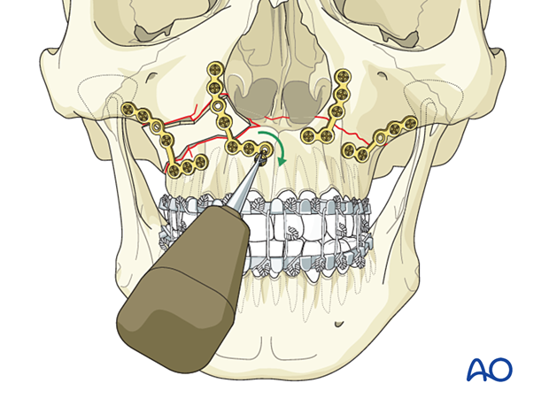 92_P140_i140 Le Fort I unilateral comminuted fracture - open reduction internal fixation: Fixation (comminution with defect)