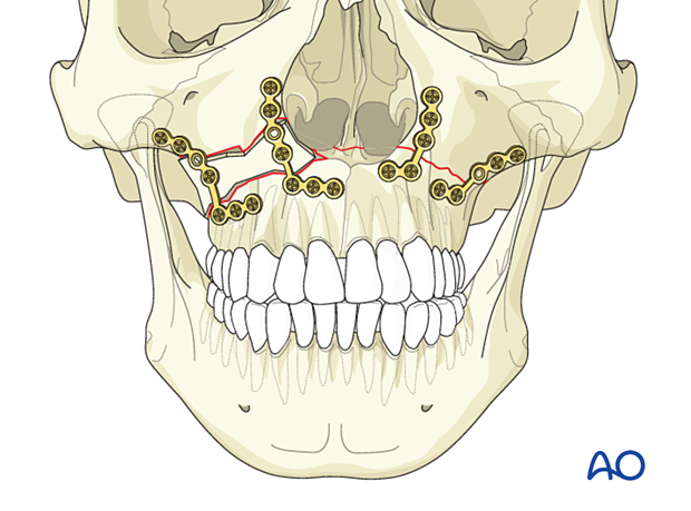 92_P140_i160 Le Fort I unilateral comminuted fracture - open reduction internal fixation: Fixation (comminution with defect)
