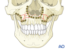 Le Fort I bilateral comminution