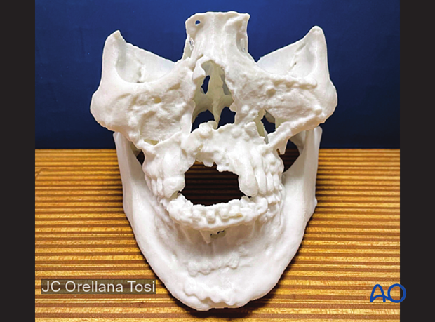 92 P150 LFI BC ORIF