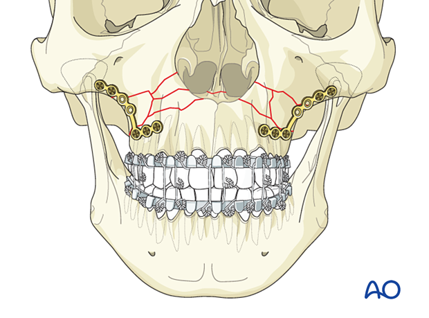 Le Fort I bilateral comminution: Fixation 