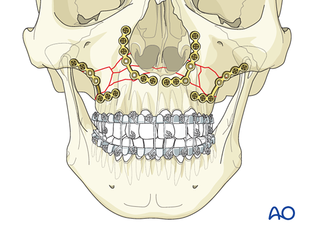 Le Fort I bilateral comminution: Fixation 