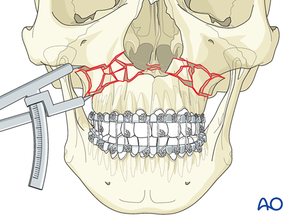 Le Fort I bilateral comminution: Fixation (with bone graft)
