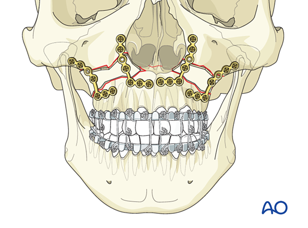 Le Fort I bilateral comminution: Fixation (with bone graft)