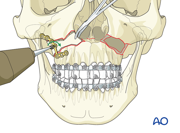 Le Fort I bilateral comminution: Fixation (with bone graft)
