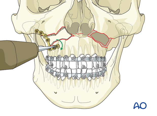 Le Fort I bilateral comminution: Fixation (with bone graft)