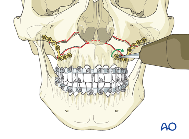 Le Fort I bilateral comminution: Fixation (with bone graft)