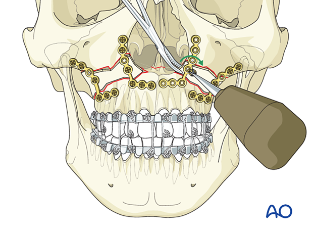 Le Fort I bilateral comminution: Fixation (with bone graft)