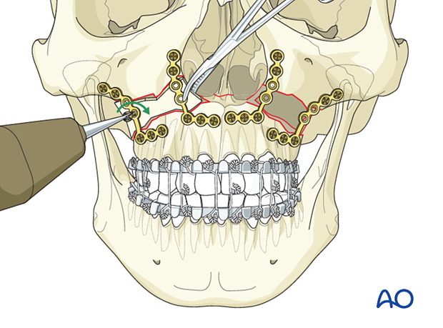 Le Fort I bilateral comminution: Fixation (with bone graft)