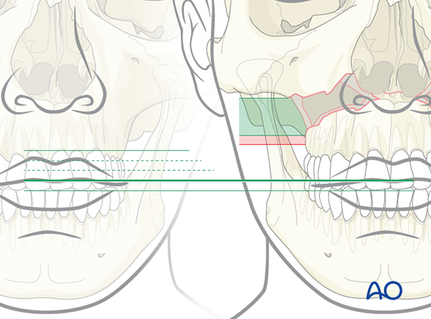 Le Fort I bilateral comminution: Fixation (with bone graft)