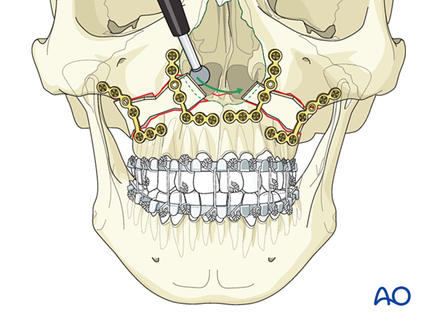 Le Fort I bilateral comminution: Fixation (with bone graft)