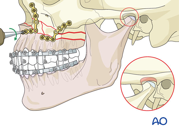 Le Fort I bilateral comminution: Check of occlusion 