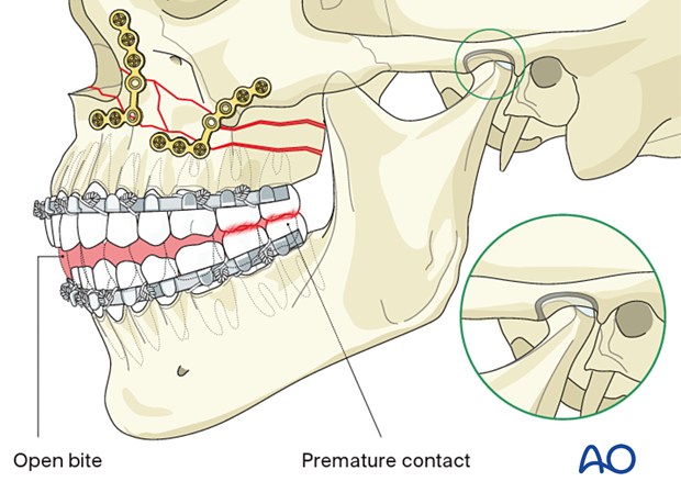 Le Fort I bilateral comminution: Check of occlusion