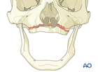 approach to the le fort i level of the midface in cleft lip and palate patients