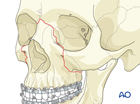 approach to the le fort i level of the midface in cleft lip and palate patients