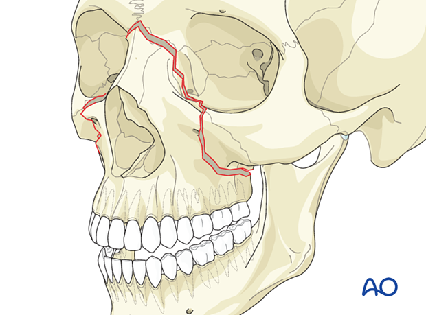 Le Fort II: Open reduction internal fixation - principles