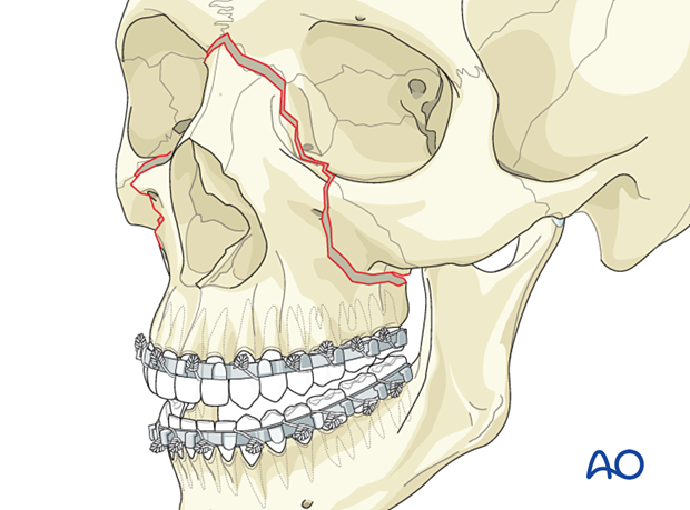 Le Fort II: Open reduction internal fixation - reduction