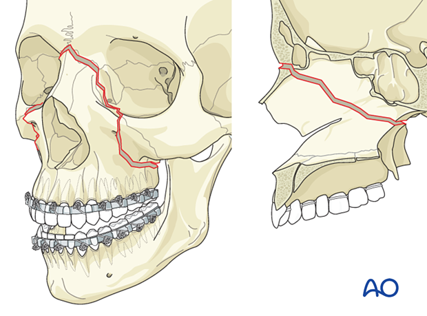 Le Fort II: Open reduction internal fixation - reduction