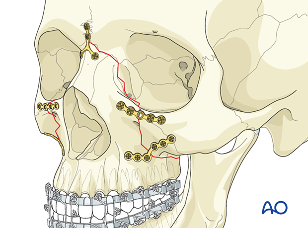 Le Fort II: Open reduction internal fixation - fixation