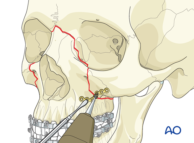 Le Fort II: Open reduction internal fixation - fixation