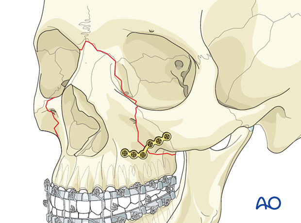 Le Fort II: Open reduction internal fixation - fixation