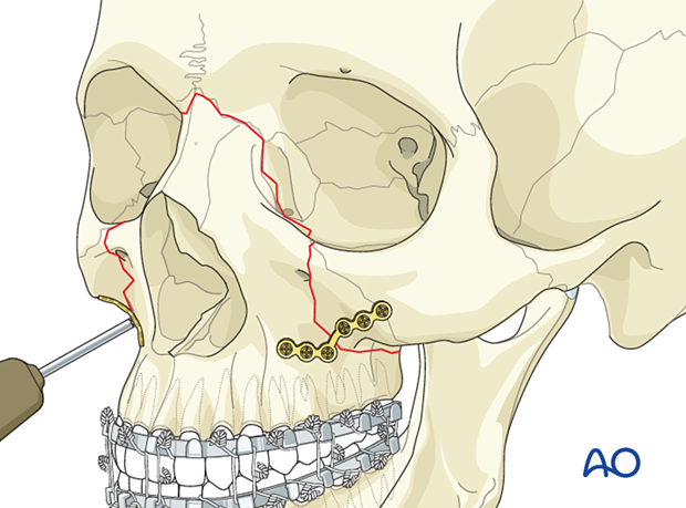 Le Fort II: Open reduction internal fixation - fixation