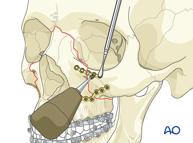 Le Fort II: Open reduction internal fixation - fixation