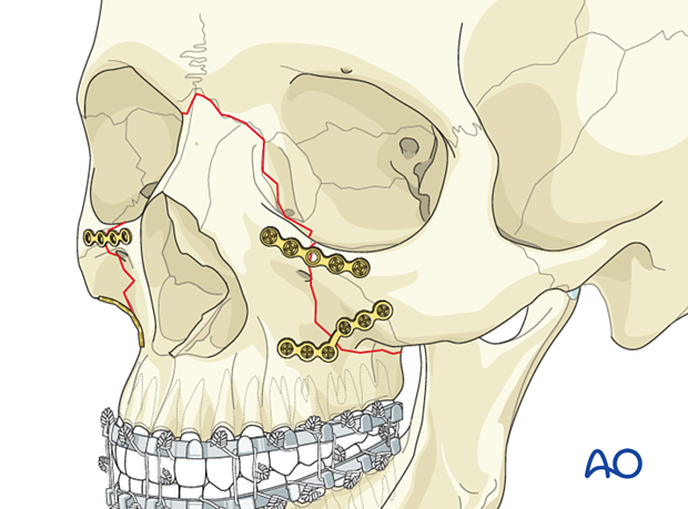 Le Fort II: Open reduction internal fixation - fixation