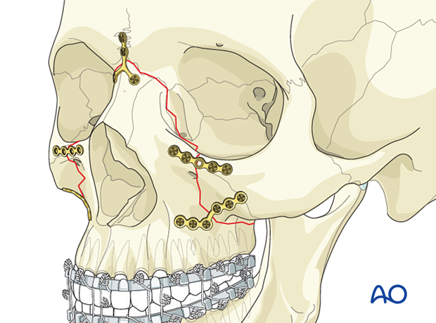 Le Fort II: Open reduction internal fixation - fixation
