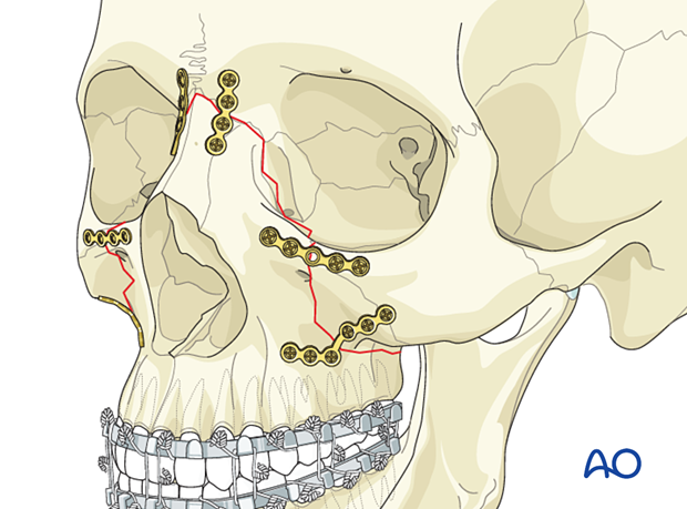 Le Fort II: Open reduction internal fixation - fixation